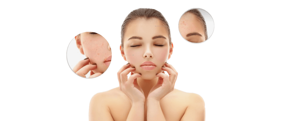 Akne: razumevanje in učinkovito zdravljenje