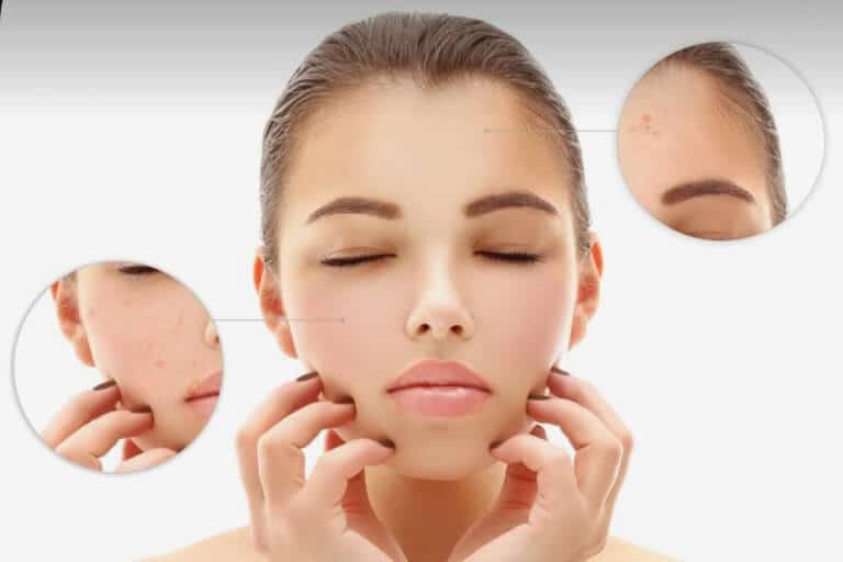 Akne, individualno svetovanje